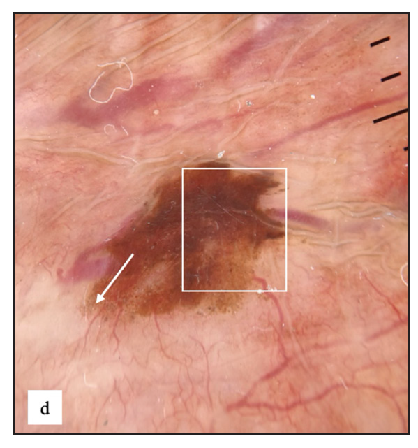 Genital melanosis dermoscopy revealed brown structureless areas with irregular feathery margin (white square) and dots, globules (white arrow).