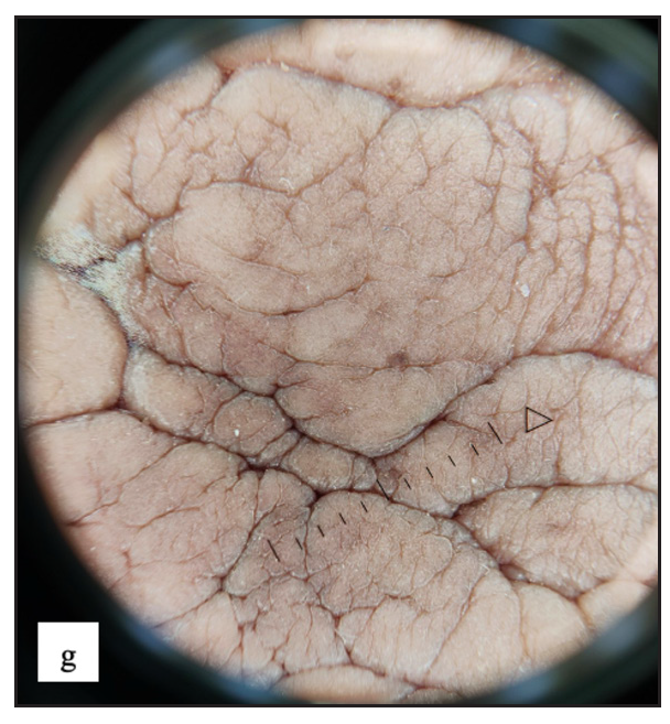 Increased rugosity mimicking sulci and gyri with brown background was noticed in dermoscopy of vulvar angiomyxoma.