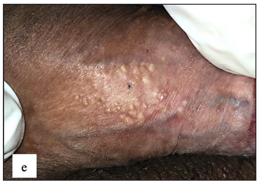 Fordyce spots showing discrete yellowish-grouped papules are present over the penile shaft.