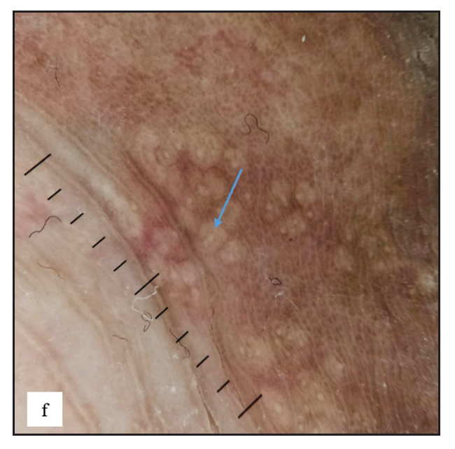 Dermoscopy of Fordyce spots depicting yellow ovoid structures with central opacity (blue arrow).