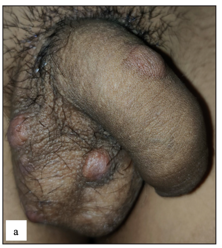 Various lesions of genital scabies. Multiple well-defined erythematous large nodules over the penile shaft and scrotum.