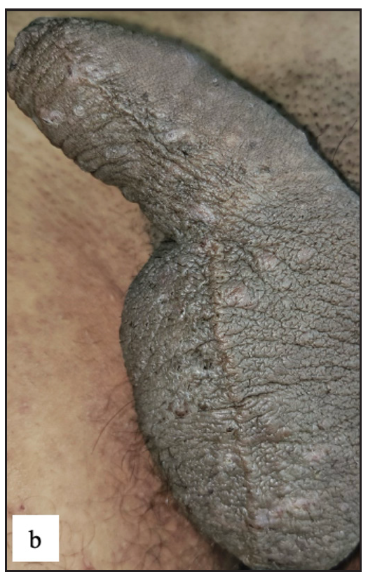 Multiple excoriated papules and burrows over the penile shaft.