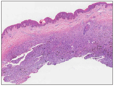 Mild epidermal hyperplasia and attenuation of dermal thickness. Tumour mass in the mid to deep dermis and subcutaneous fat showing a diffuse infiltrative growth pattern with fatty replacement and scattered pigment (Haematoxylin and eosin, 20x).