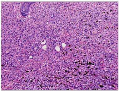 Large quantities of spindle tumour cells are arranged in a storiform pattern, invading and dividing the adipocytes into a honeycomb pattern, partly surrounding small blood vessels and adnexa. Scattered pigment cells can be seen (Haematoxylin and eosin, 100x).