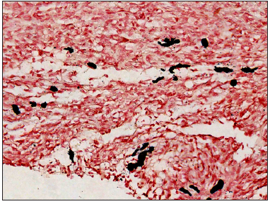 Black granules seen are evidence that pigment is melanin (Masson-Fontana stain, 400x).