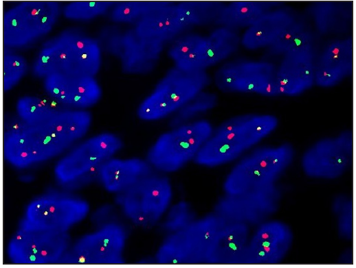 Translocation recombination of COL1A1/ PDGFB gene was detected (FISH).