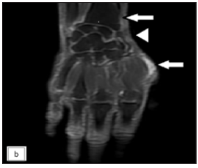 Coronal post contrast T1-weighted MRI of right hand showing two focal enhancing thickening of the synovial sheath of abductor pollicis longus and extensor pollicis tendons at the lateral aspect of the wrist and the level of the first metacarpal head (white arrows -first and third nodules). The thickening is also noted extending to involve the adjacent superficial branch of the radial nerve (white arrow head).