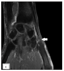 Coronal post contrast T1-weighted MRI of right hand showing another focal enhancing thickening of the synovial sheath of abductor pollicis longus and extensor pollicis tendons at the level of first metacarpal base (white arrow-second nodule).