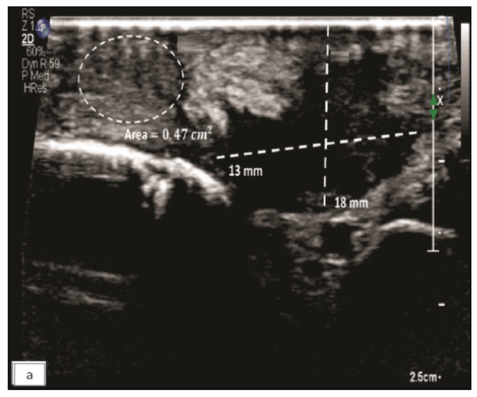 Greyscale high-resolution ultrasound image of right hand showing a heterogeneous hypoechoic lesion in the skin and subcutaneous tissue (dotted lines) over the cubital fossa with thickened and heterogeneous superficial branch of the radial nerve (dotted circle) which is involved by the lesion.