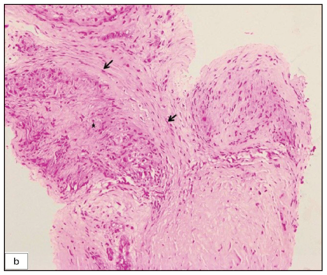 Biopsy of the superficial branch of radial nerve depicting nerve bundles (black arrows) and an eccentric granuloma (asterisk) (Haematoxylin & eosin, 200x).