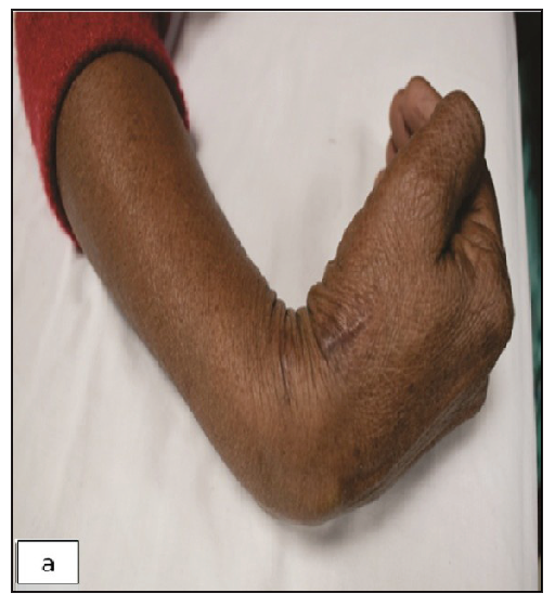 Completely resolved nodules post anti-tubercular therapy at 18 months with a longitudinal scar at the site of biopsy.