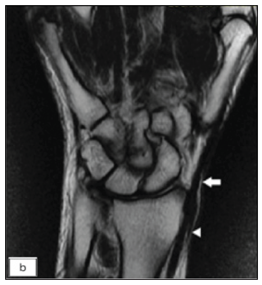 Coronal T2-weighted MRI of the right hand, post 18 months of anti-tubercular therapy, shows complete resolution of synovial thickening along the tendons (white arrow)and normalisation of thecalibre of the superficial branch of the radial nerve (white arrow head).