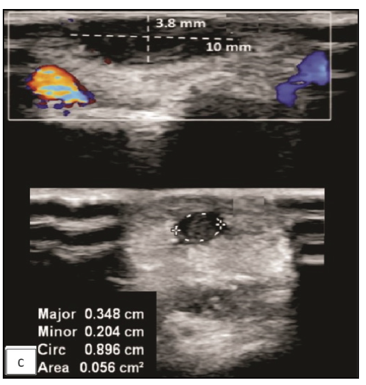 Nine-month follow-up Greyscale high-resolution ultrasound image of the right hand showing significant reduction in the size and vascularity of the cutaneous lesion in the skin and subcutaneous tissue (dotted lines) at the cubital fossa with a reduction in the size of the superficial branch of the radial nerve (dotted circle).