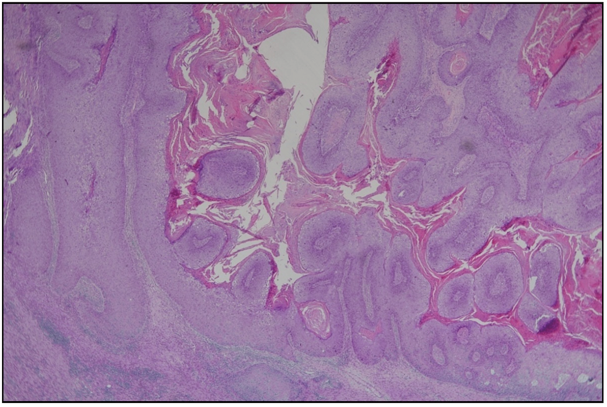 Papillomatous condylomatous hyperplasia of the epidermis with full-thickness dysplasia. (Haematoxylin & eosin, 20x).