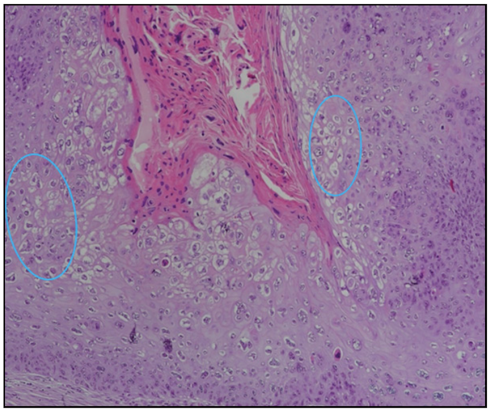 Full-thickness dysplasia in the epidermis and koilocytotic changes (blue circles) (Haematoxylin & eosin, 200x).
