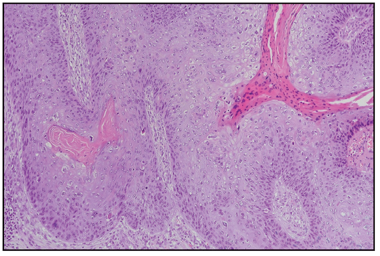 Invasive squamous cell carcinoma nests in the dermis below condyloma acuminatum. Haematoxylin and eosin, 100x).