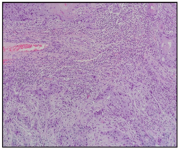 HPV6/11 positivity at chromogenic in situ hybridisation (Haematoxylin and eosin, 200x).