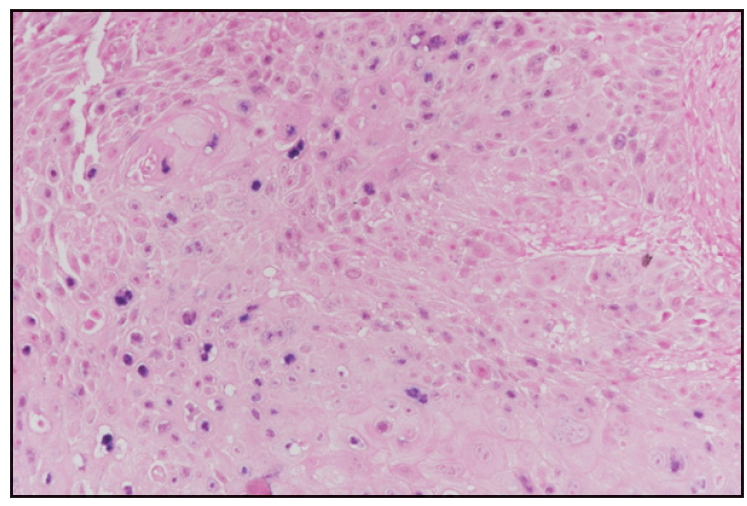 Invasive areas of SCC seen in the dermis below condyloma acuminatum (Haematoxylin and eosin, 100x).