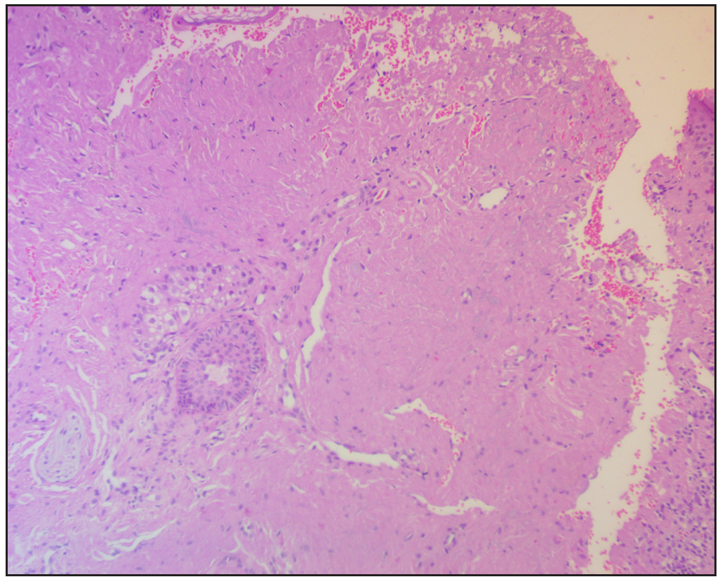 Histopathology showing deposition of eosinophilic amorphous material in the dermis (Haematoxylin and eosin, 100x)