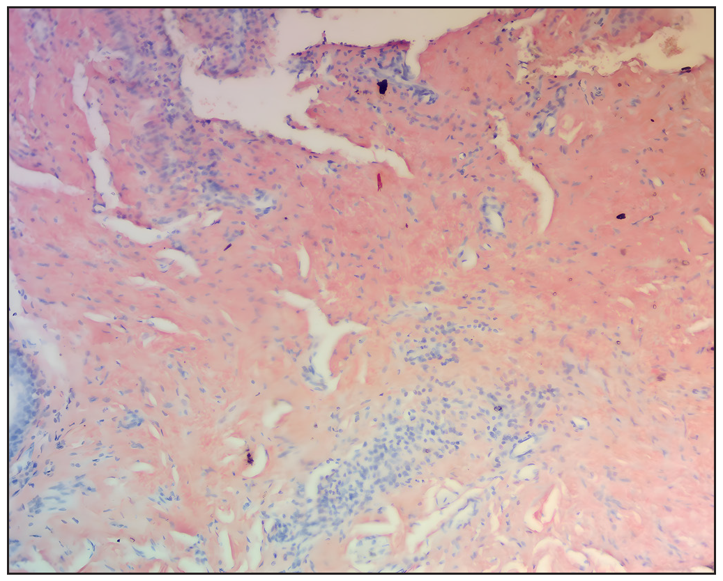 Congo red stain showing amorphous eosinophillic amyloid deposits in the upper and mid dermis (original magnification ×100)