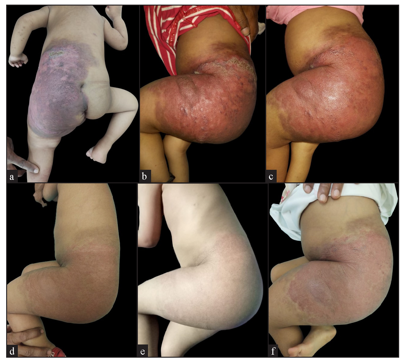 Clinical images of a child showing a well-defined erythematous nodulo-plaque with diffuse swelling over the abdomen, gluteal region, and left thigh, including (a) baseline front and (b) lateral views, (c-e) progressive changes during follow-up, and (f) the clinical images after six months of treatment.