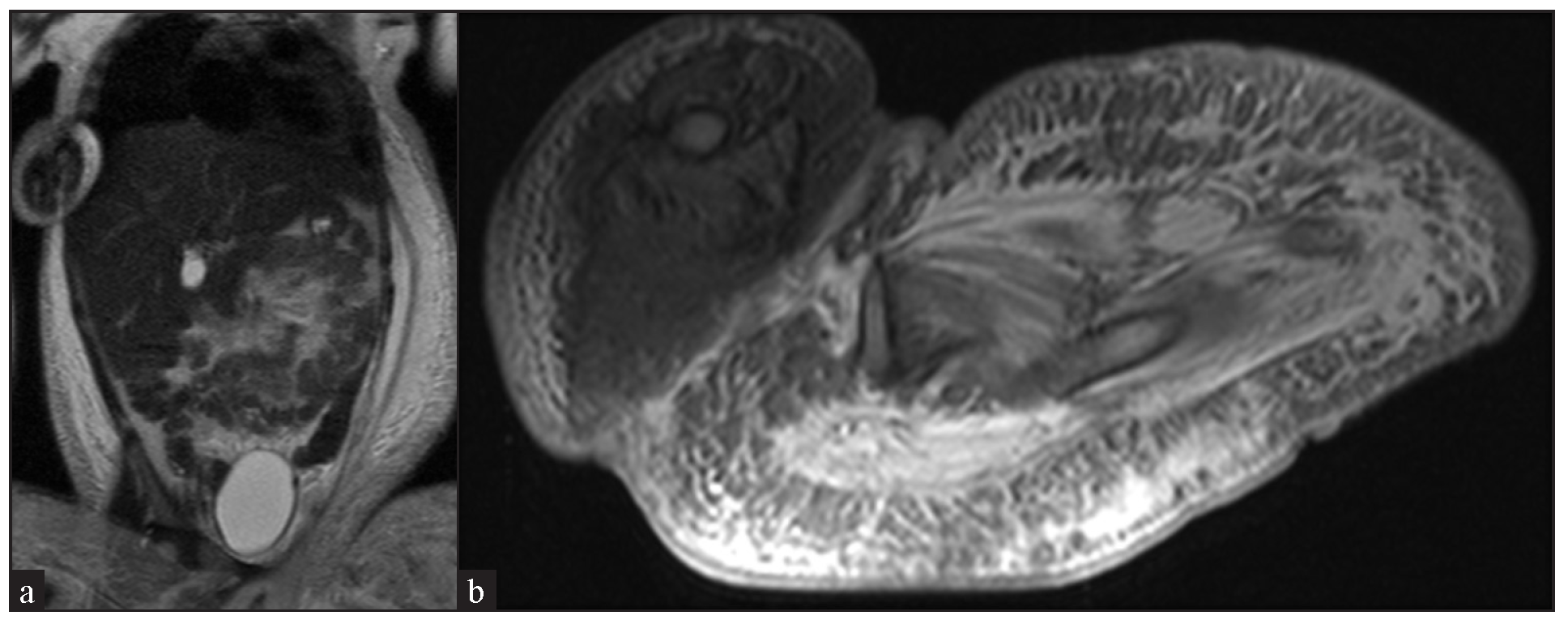 Contrast-enhanced magnetic resonance imaging of abdomen and thigh showing enhanced soft tissue swelling and possible veno-lymphatic malformation in T2 (a) Coronal section and (b) axial section.