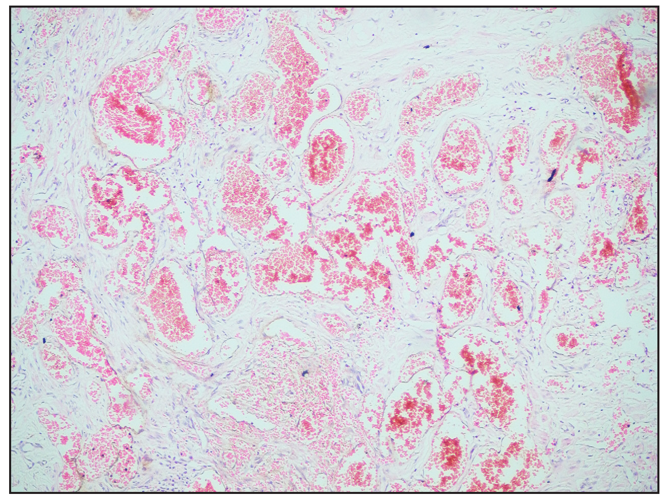 Histopathological image showing numerous ectatic and congested vascular channels (Haematoxylin and eosin, 10×).