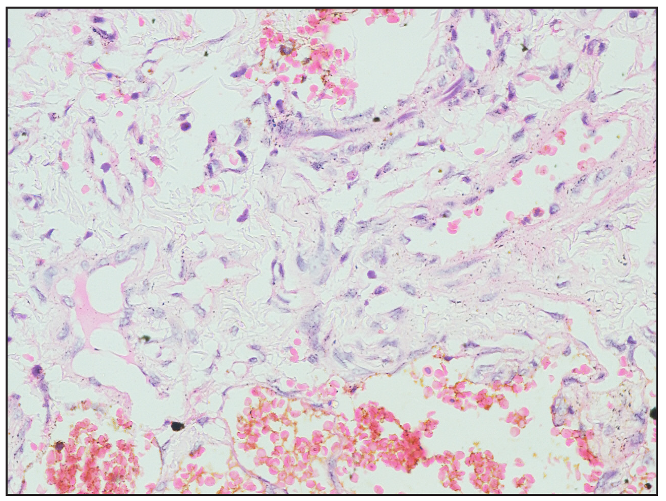 Histopathological images showing flattened endothelial lining and spindle to fibroblast-like cells (Haematoxylin and eosin, 40×).