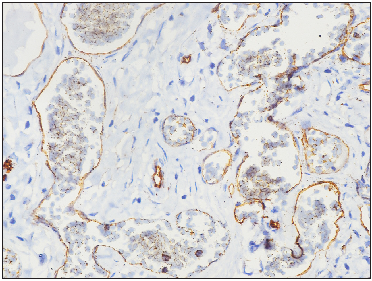 Immunohistochemistry image showing CD34 highlighting the ectatic vascular lumens (40× magnification).