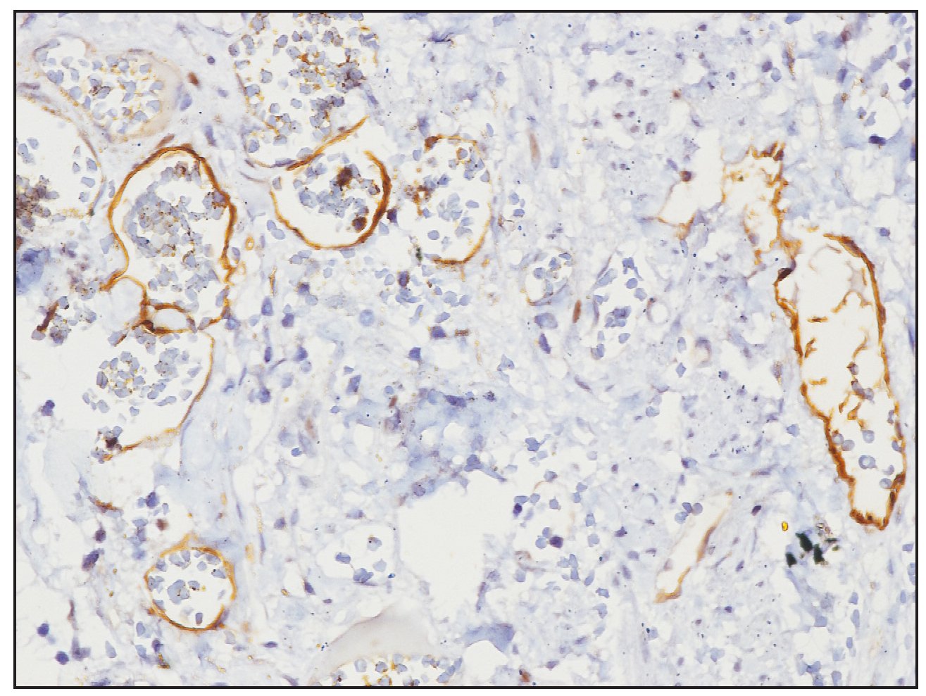 Immunohistochemistry image showing D2-40 highlighting the ectatic vascular lumens (40× magnification).