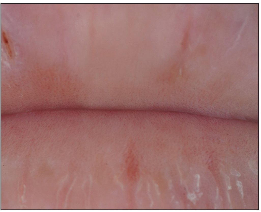 Dermoscopic finding at the three months after the final session of patient 2 (Polarised mode, 20x).