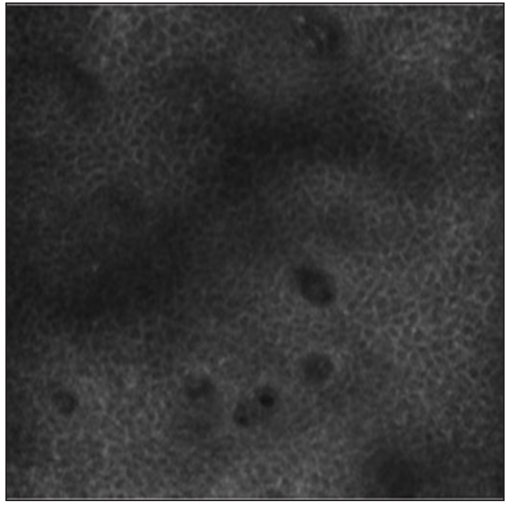 RCM image at the three-month post the final treatment session of patient 1.