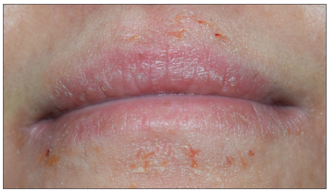 Pre-treatment clinical photograph of patient 2.