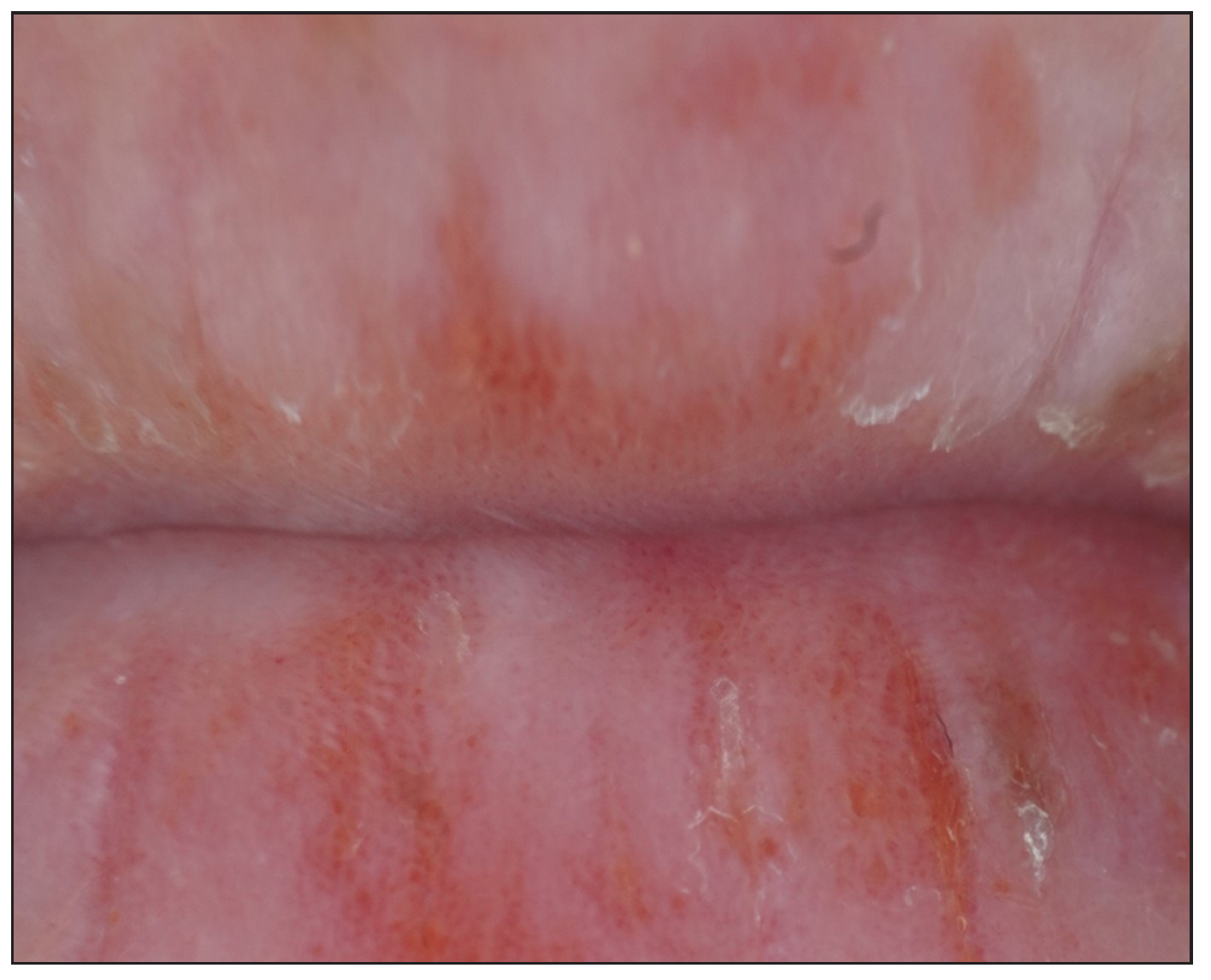 Dermoscopic finding before the initial treatment of patient 1 (Polarised mode, 20x).