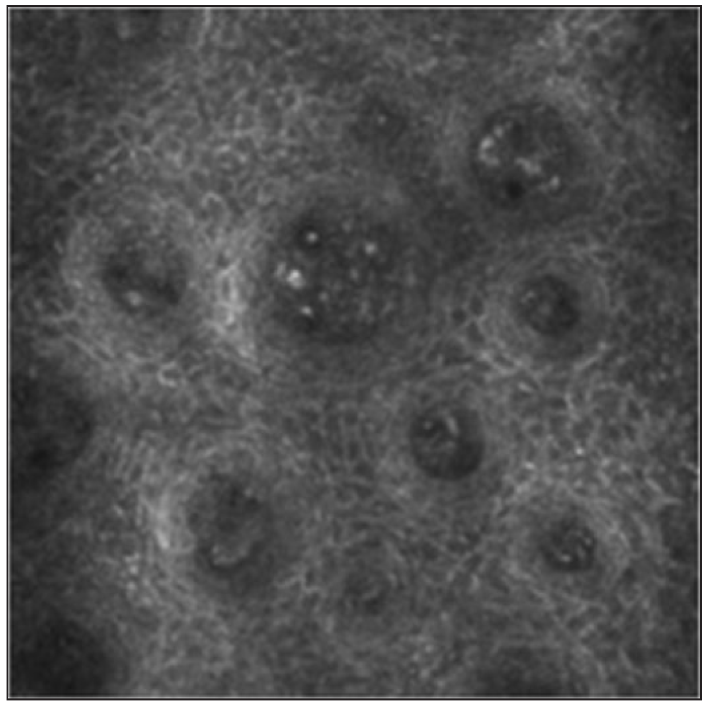 Reflectance confocal microscopy (RCM) image prior to the first treatment session of patient 1.