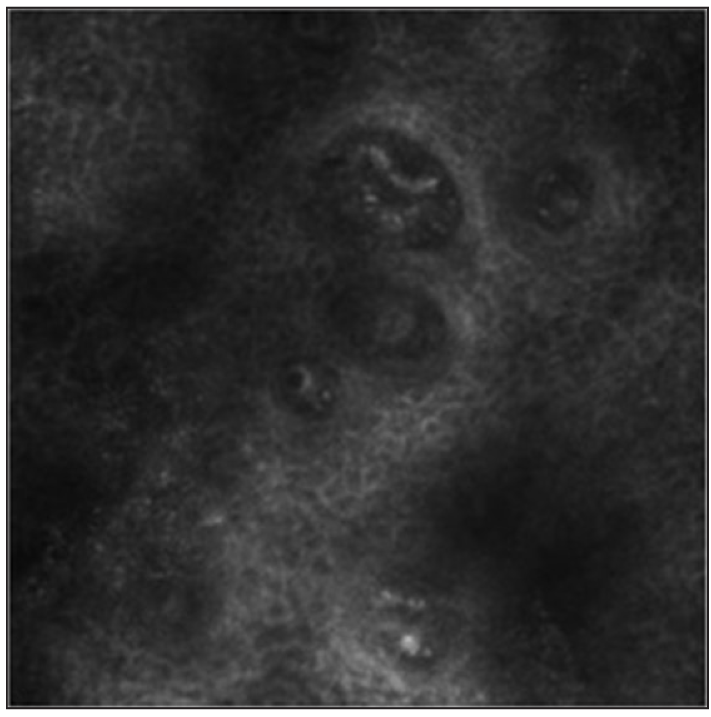 Reflectance confocal microscopy (RCM) image was captured prior to the first therapeutic intervention of patient 2.