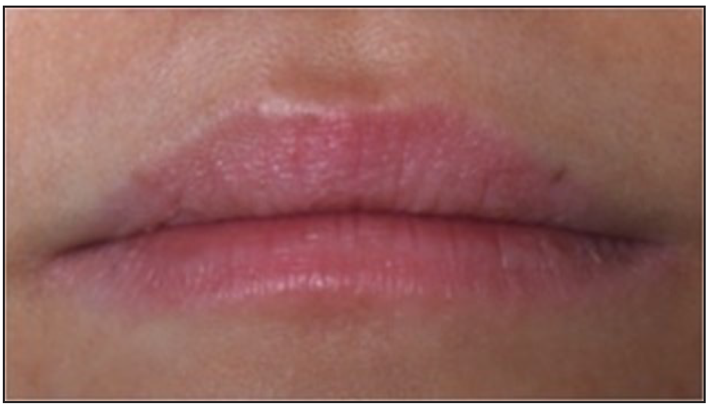 Clinical appearance at the three months after the last treatment of patient 2.