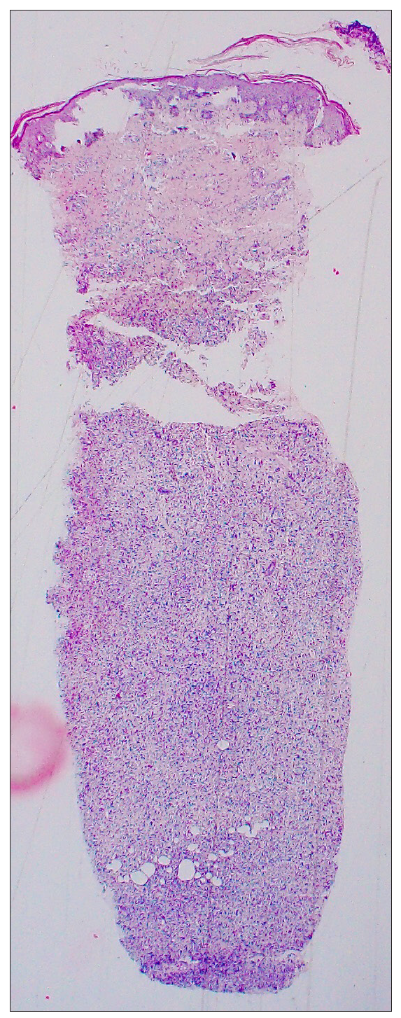 The epidermis showed hyperkeratosis and spongiosis. The superficial dermis showed mild to moderate perivascular inflammation composed of lymphocytes, plasma cells, neutrophils, and histiocytes. The deeper dermis showed sheets of atypical large lymphoid cells (Haematoxylin and eosin, 40x).