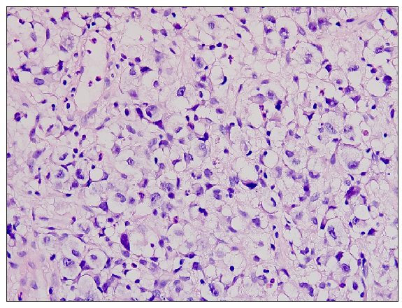 On higher magnification, these cells were seen to have pleomorphic hyperchromatic nuclei with irregular nuclear membrane and moderate to abundant clear cytoplasm. Overall features were suggestive of anaplastic large cell lymphoma (clear cell variant) (Haematoxylin and eosin, 200x).