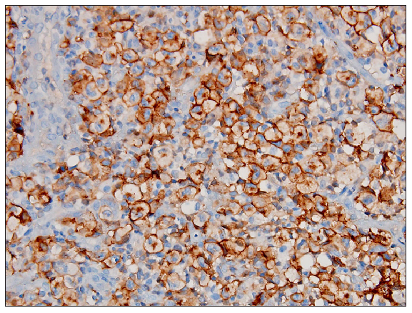 Atypical lymphoid cells were diffusely positive for CD30 (membranous with golgi zone accentuation) (200x).