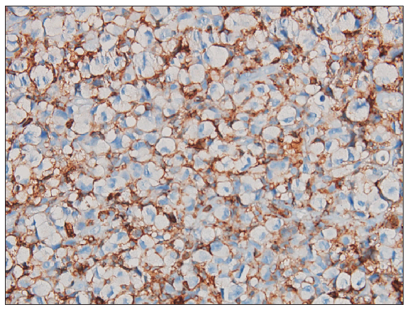 On immunohistochemistry, the atypical lymphoid cells were diffusely positive for CD45 (200x).