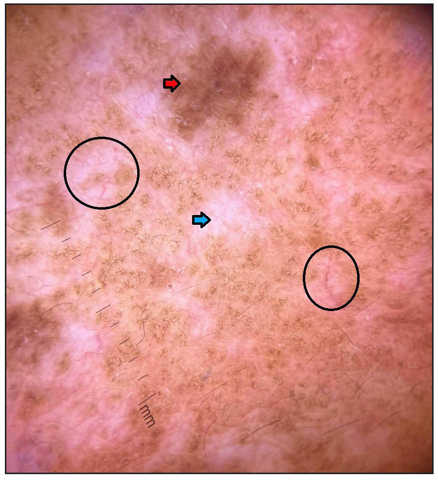 Dermoscopy reveals a shiny white structureless area with telangiectasia (black circle), along with structureless white area (blue arrow) and lentigo-like pigmentation (red arrow) [Dermlite DL4, 10x, polarised].