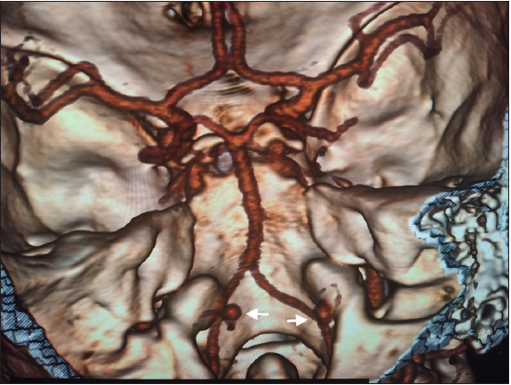 Computed tomography angiography image of the brain showing bilateral aneurysms at the origin of the posterior inferior cerebellar artery (white arrows).