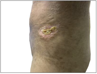 Scleroderma-like chronic cutaneous lesions with multiple sclerotic plaques and pigmentation changes on the trunk.