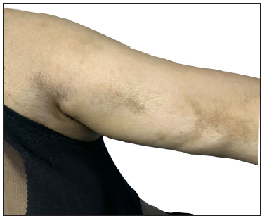 Scleroderma-like chronic cutaneous lesions with multiple sclerotic plaques and pigmentation changes on the upper limb.