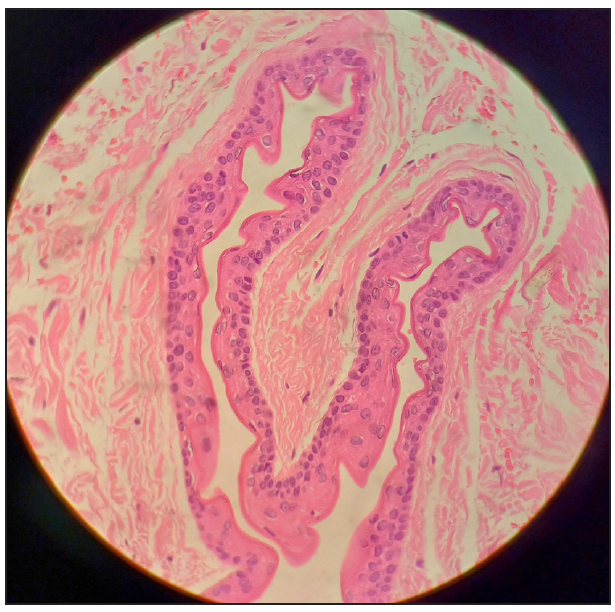 Serpiginous thin walled dermal cyst with sebaceous glands and an empty lumen (Haematoxylin and eosin; 400×).