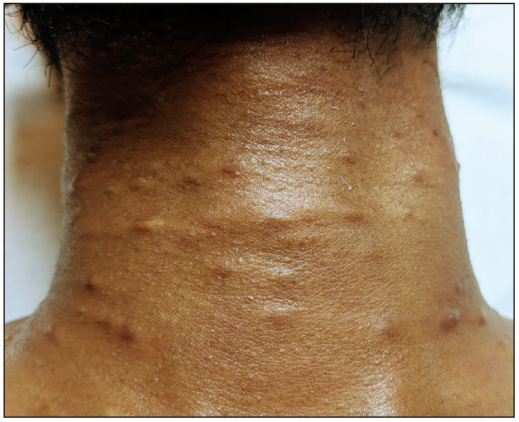 Post-treatment outcome following two sessions of intralesional polidocanol injection demonstrating a reduction in the size and resolution of some cysts with post-procedure hyperpigmentation.