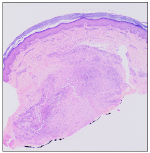 Sclerotic nodule in the deep dermis and overlying normal epidermis (Haematoxylin and eosin, 20x).