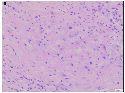 Foamy histiocytes and sparse lymphocytes in sclerotic nodules (Haematoxylin and eosin, 400x).