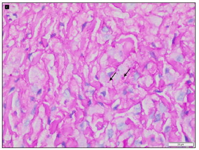 Intracytoplasmic alcian blue positive material and periodic acid schiff positive deposits (black arrows) (periodic acid schiff-alcian blue stain with diastase, 400x).